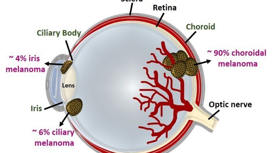 Uveal Melanoma – The Irish Challenge - Breakthrough Cancer ...